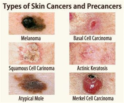 non melanoma skin cancer vs melanoma